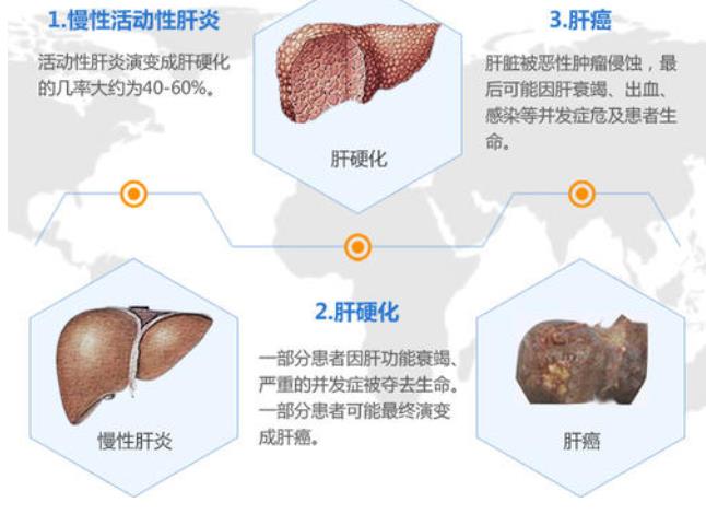 肝炎