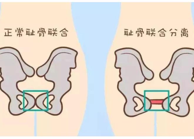 耻骨联合分离