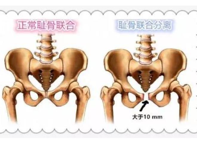 耻骨联合分离