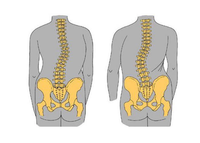 脊柱侧弯