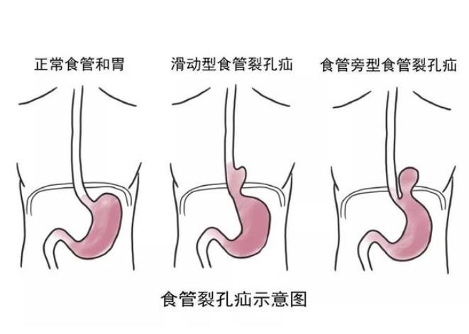 食管裂孔疝