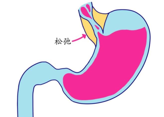 食管裂孔疝