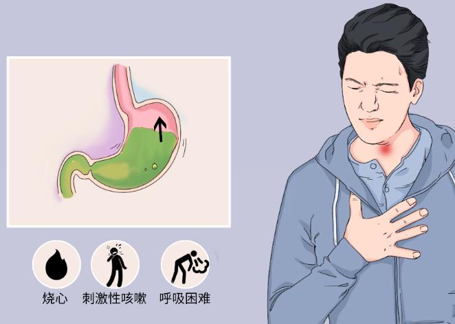 胃食管反流病