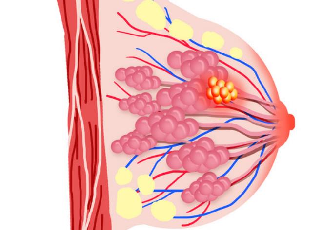 乳腺肿瘤