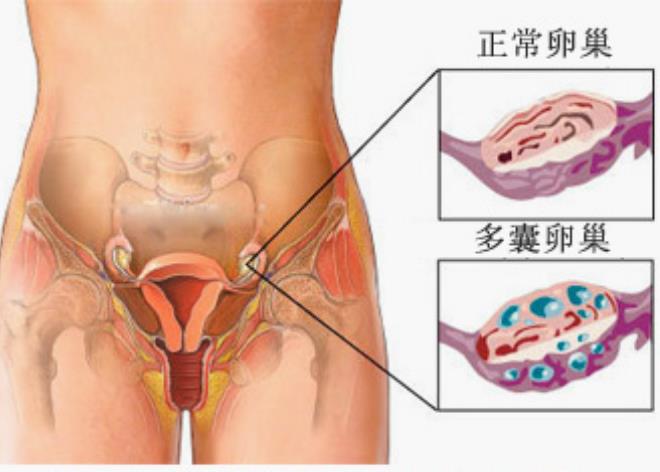 多囊卵巢综合征