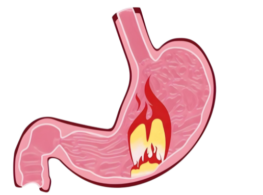 反流性食管炎