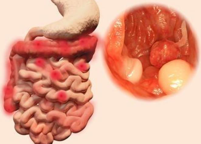 什么检查能发现结肠息肉？切除结肠息肉能防止结肠癌吗？