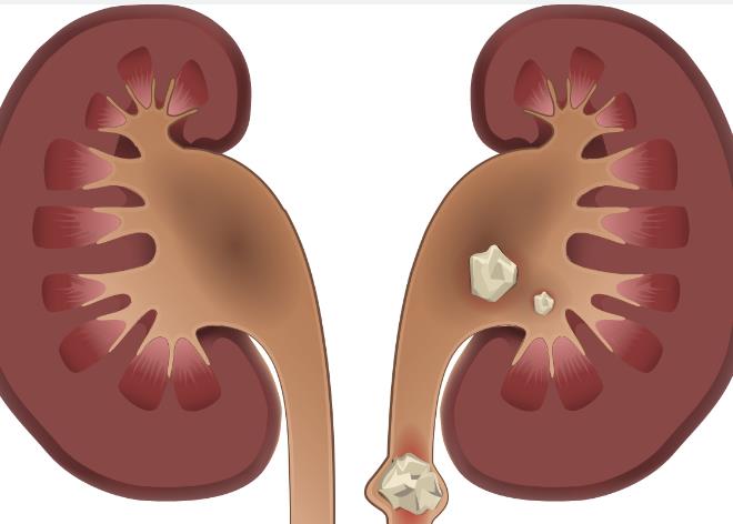 为什么会得肾结石？检查这五个因素，不要忽略