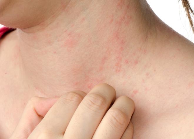 你有没有被湿疹所困扰呢？皮肤科医生一文聊聊它的这些事