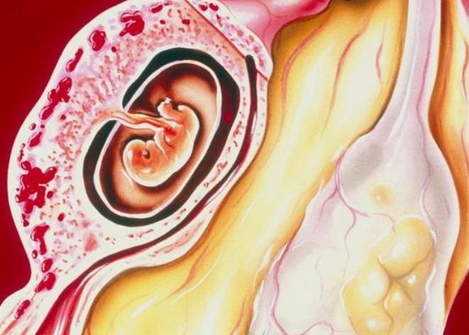 宫外孕很危险，宫外孕的症状有哪些？做哪些检查可以发现宫外孕？