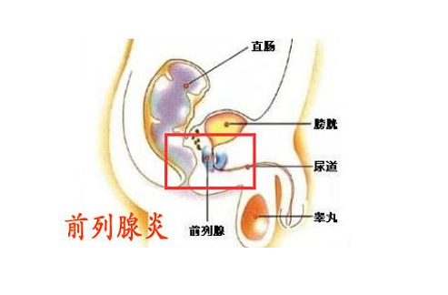 前列腺炎