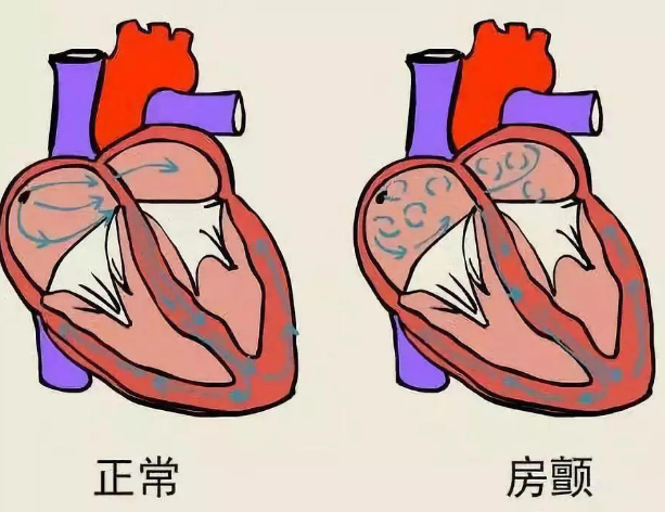 心房颤动