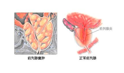 前列腺囊肿