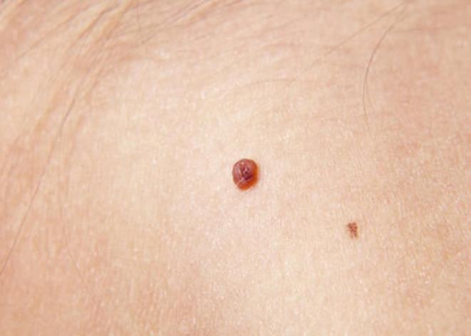人头乳瘤病毒图片图片