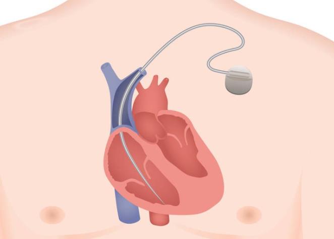 植入式心律转复除颤器