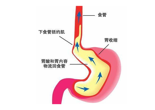 胃食管反流