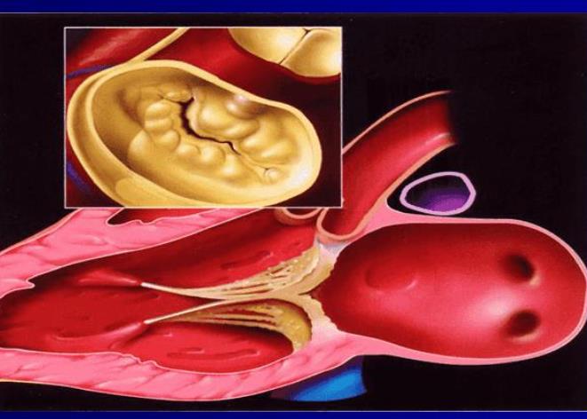 二尖瓣狭窄