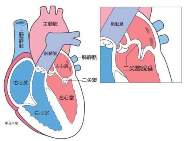 二尖瓣脱垂