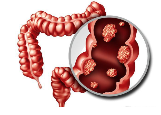 家族性腺瘤性息肉病