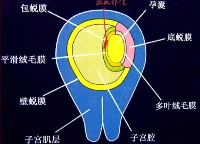 绒毛膜下血肿