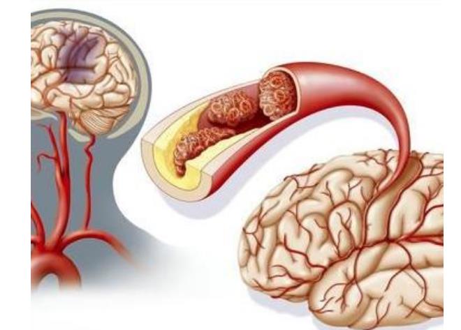 脑血栓