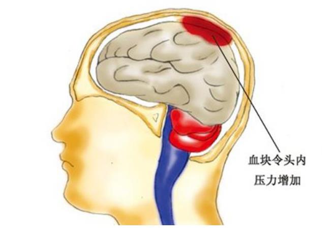 脑出血