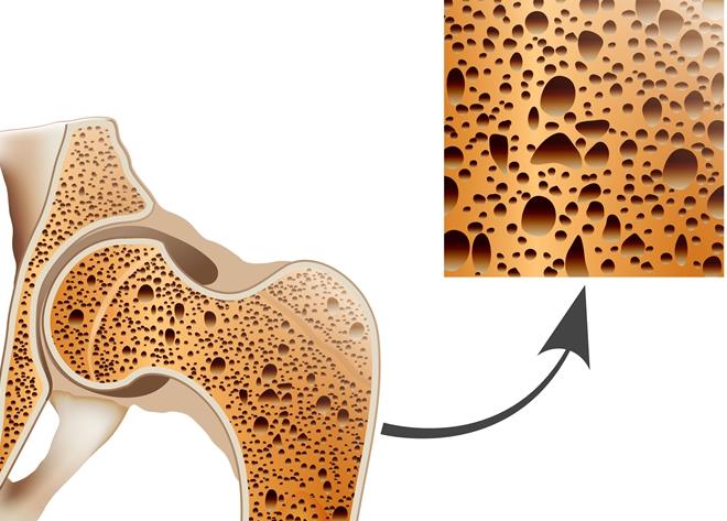 骨质疏松症