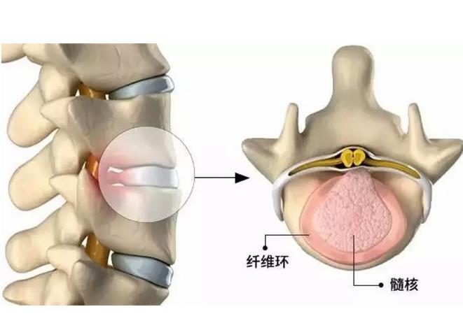 腰椎肩盘突出