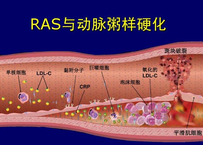 动脉粥样硬化