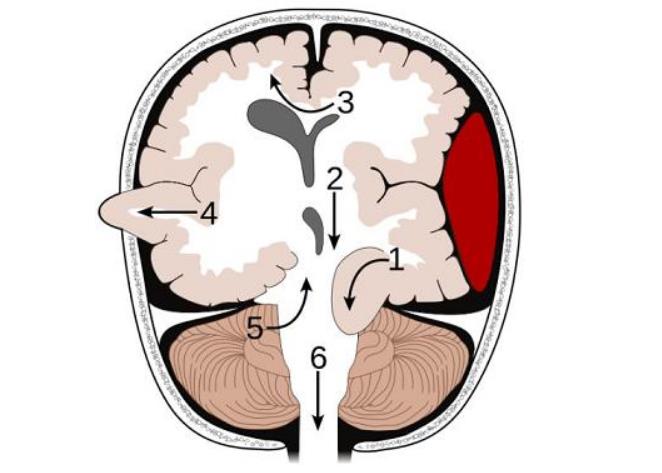 脑疝