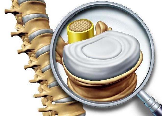 退行性椎间盘疾病