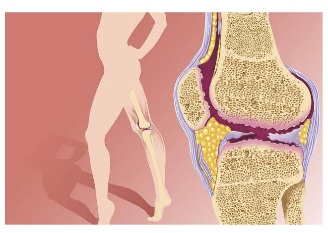 骨关节炎