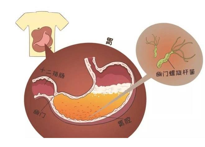 胃溃疡