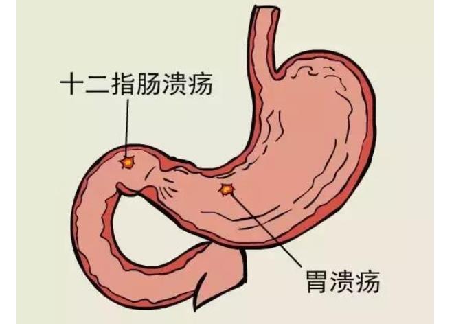 胃食管反流