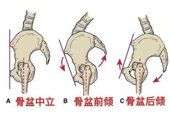 被羡慕是s型身材,殊不知可能是骨盆前倾,一个动作教你自测!