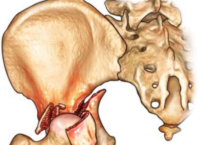 髋臼骨折