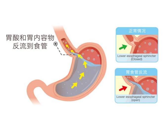 胃食管反流