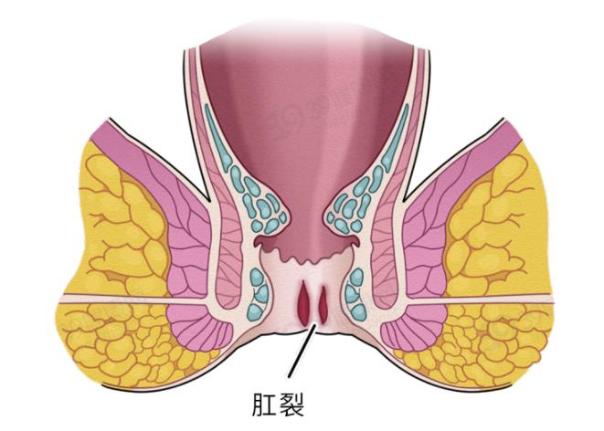 肛裂