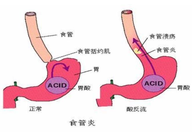 反流性食管炎