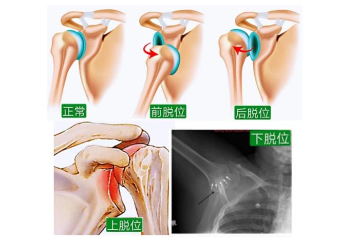 肩关节脱位