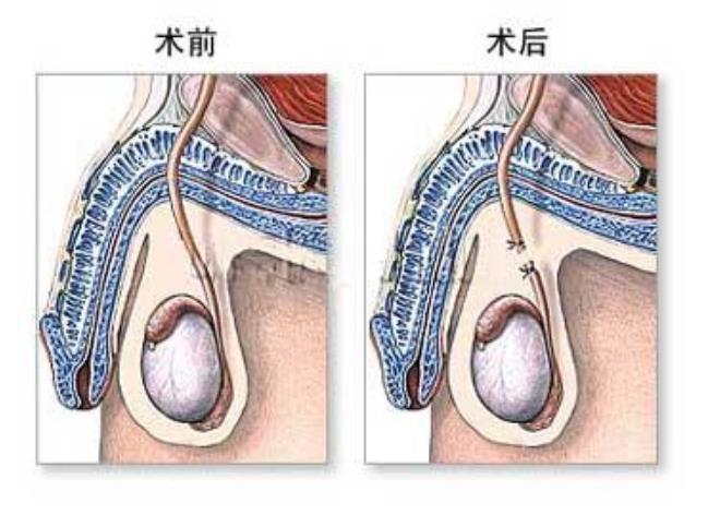 男性结扎和复通