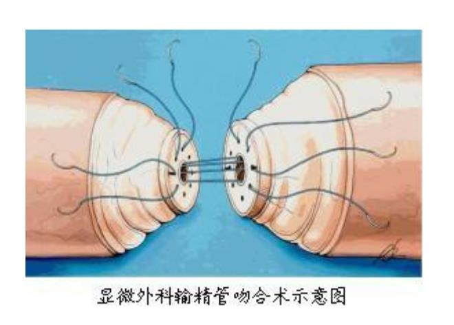 男性结扎和复通