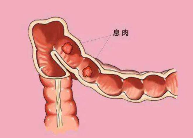 息肉