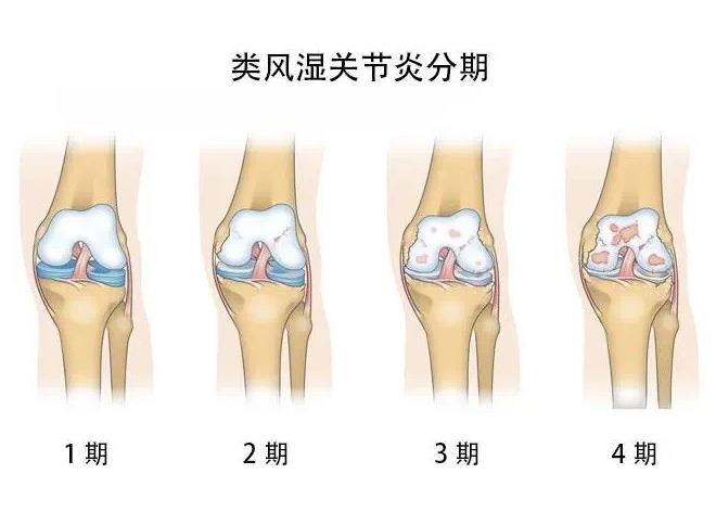 类风湿性关节炎