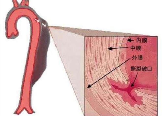 主动脉夹层