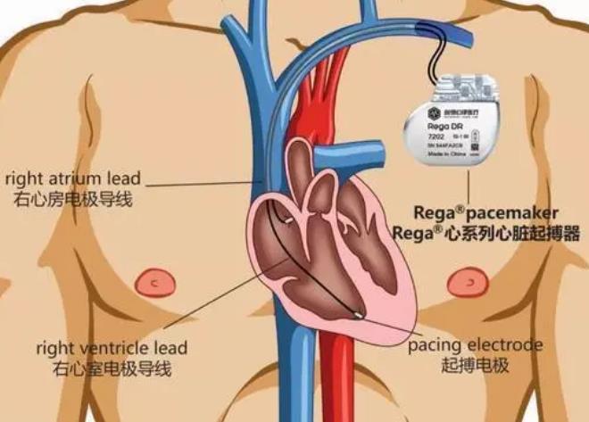 心脏起搏器