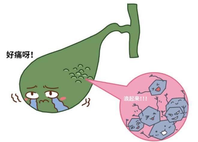 胆囊结石卡通图片图片