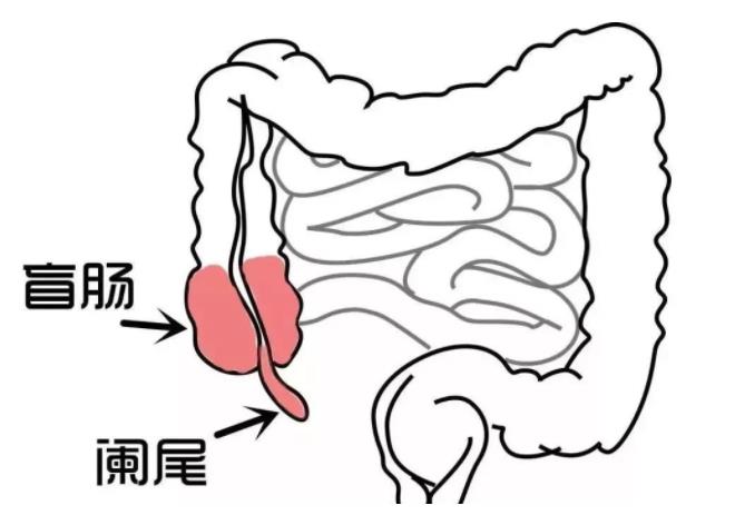 阑尾炎