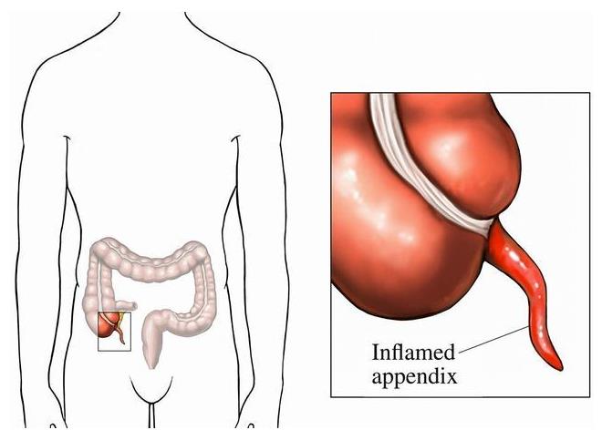 阑尾炎