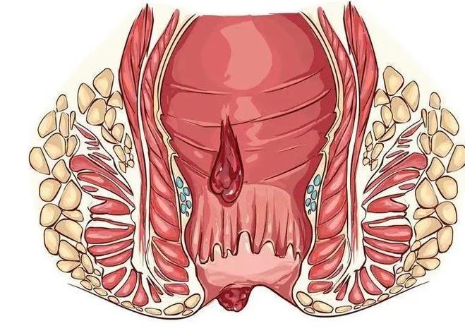 肛裂